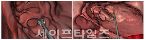 ▲ CT로 찍은 실제 환자 부비동 영상으로 재구성한 가상 수술환경에서 수술하고 있다. ⓒ 서울대병원