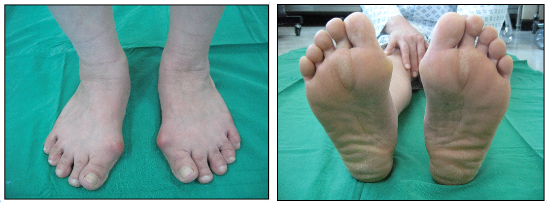 ▲ 무지 외반증 환자의 발. ⓒ 대한정형외과학회