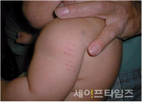 ▲ 경피용 결핵 백신을 접종한 아기 ⓒ 공정위