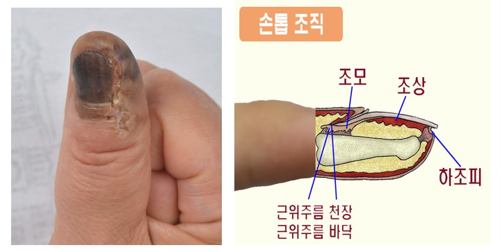 ▲ 손발톱밑 흑색종(악성 조갑하 흑색종) ⓒ 서울대병원