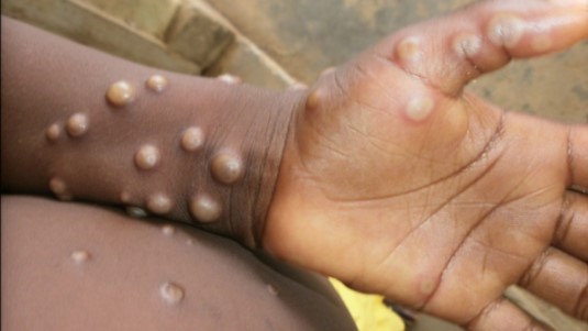 ▲ 원숭이두창 환자의 피부 증상 ⓒ 나이지리아 질병통제센터