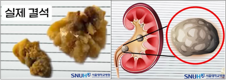 ▲ 실제 요로결석의 모양(왼쪽)과 요로결석의 발생 과정. ⓒ 서울대병원