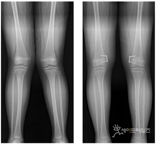 ▲ 교정전 엑스자 다리(왼쪽)에 대해 8자 금속판을 이용한 대퇴골 내측 반성장판 유합술하고 교정된 다리. ⓒ 분당서울대병원