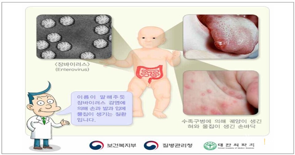 ▲ 질병관리청이 최근 영유아(0~6세)를 중심으로 수족구병 환자 수가 크게 증가하고 있어 영유아가 있는 가정과 관련 시설에서의 수족구병 예방수칙 준수를 당부했다. ⓒ 질병관리청