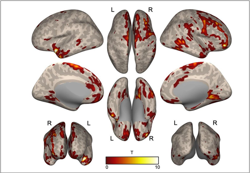 ▲ 전체 그룹 간 비교. ADHD 그룹은 정상 그룹에 비해 좌측 상측 측두엽 및 우측 중간 전두엽의 혈류량이 낮았다. ⓒ 서울대병원