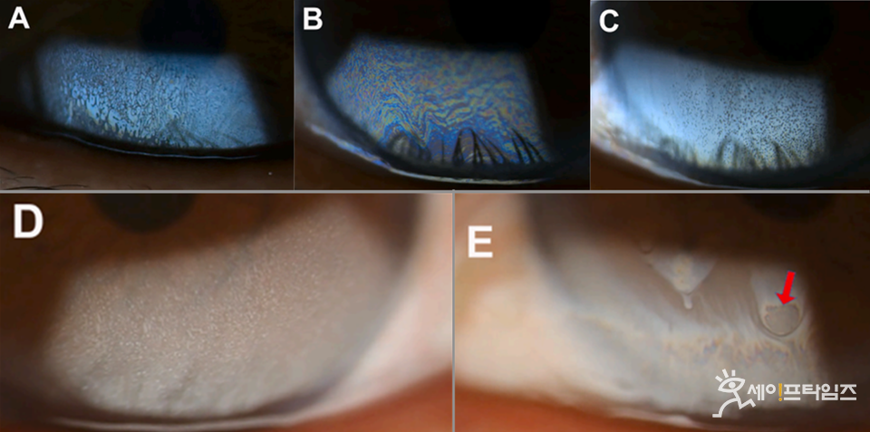 ▲ LED 면광원과 세극등 현미경으로 관찰한 다양한 화장품 오염 패턴. (A)마블링, (B)너무 많은 색상, (C)검은 점, (D)흰 점, (E)건조 영역(빨간색 화살표). ⓒ 여의도성모병원