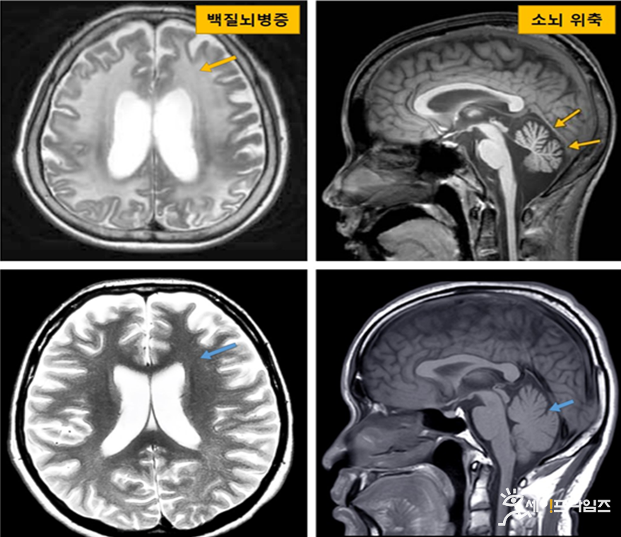 ▲ 신경세포핵내봉입체병 환자(윗줄)와 정상인(아래줄)의 뇌MRI 사진을 비교해보면 신경세포핵내봉입체병 환자는 백질 영역이 하얗게 보이는 백질뇌병증 소견(윗줄 왼쪽)과 소뇌 위축 소견(윗줄 오른쪽)이 나타나고 있다. ⓒ 게티이미지뱅크(정상인 뇌MRI 영상)