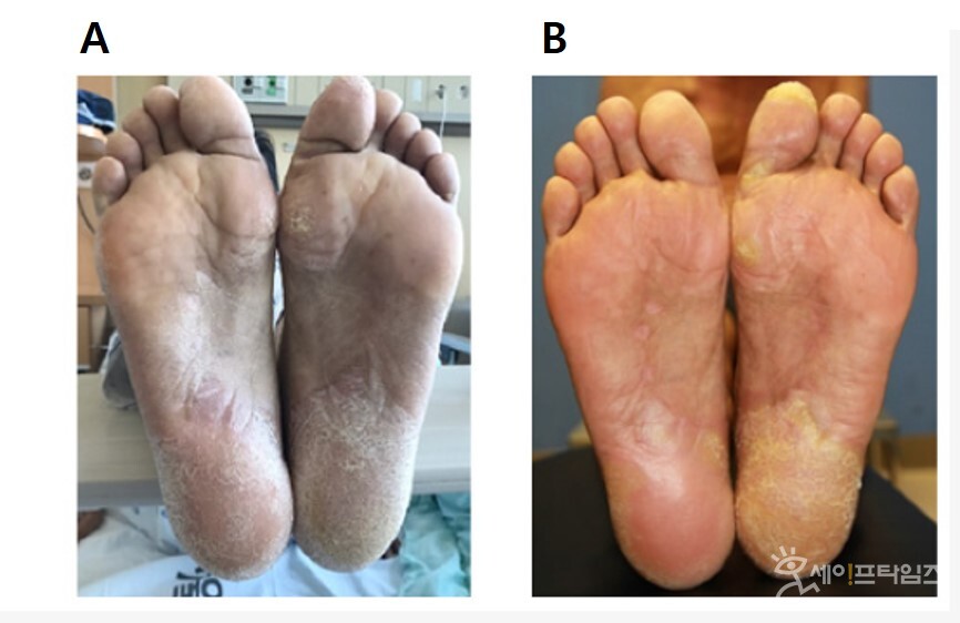 ▲ 조석구 교수 연구팀(교신저자) 연구팀(공동저자 민기준·이종욱 혈액내과 교수, 정낙균 소아청소년과 교수, 오은지 진단검사의학과 교수, 김나연 제1저자 가톨릭의대 중개의학분자영상연구소 박사)이 혈액암 환자의 치료 과정에서 발생하는 심각한 합병증인 만성 이식편대숙주질환(cGVHD)을 치료할 수 있다는 연구 결과를 발표했다. ⓒ 서울성모병원