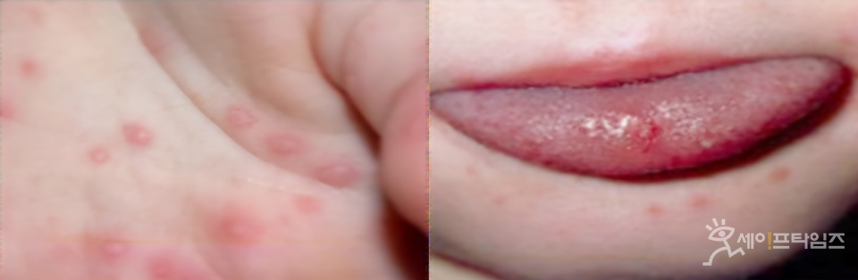 ▲ 수족구병에 걸린 환자의 손과 입 주위에 생긴 물집이 생긴 모습. ⓒ 질병청