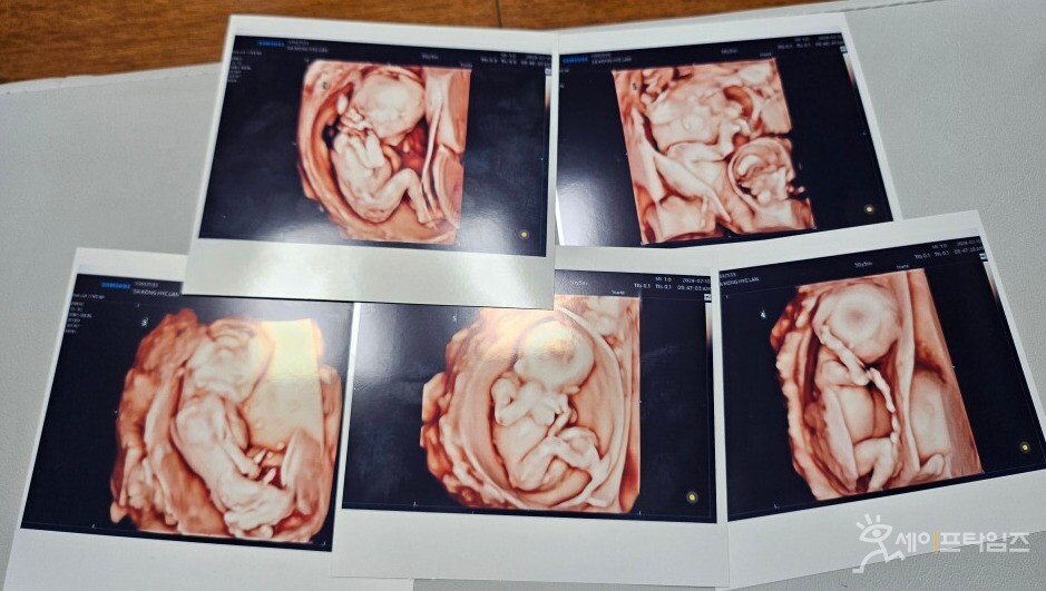 ▲ 자연임신으로 생긴 다섯쌍둥이의 초음파사진. ⓒ 서울성모병원
