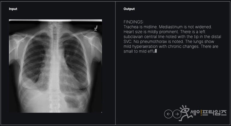 ▲ 숨빗AI의 AI Read-CXR이 흉부엑스레이 영상을 바탕으로 소견을 제공하고 있다. ⓒ 숨빗AI