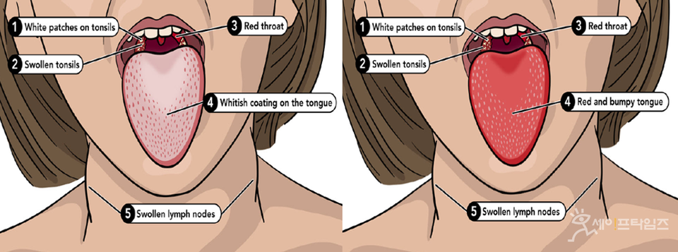 ▲ 성홍열 혀의 주요 증상으로 처음에는 회백색이 덮이고 돌기가 현저히 두드러지는 모양(왼쪽)에서 발병 후 2∼3일 지나면 붉은색을 띠고 돌기가 붓는 딸기 모양으로 새빨간 혀로 변함. ⓒ 질병청