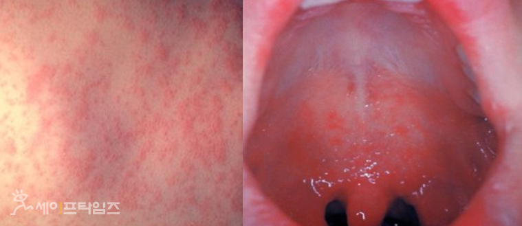 ▲ 홍역의 특징적인 증상으로 발진(왼쪽)와 구강 내 Koplik 반점(오른쪽). ⓒ 식약처